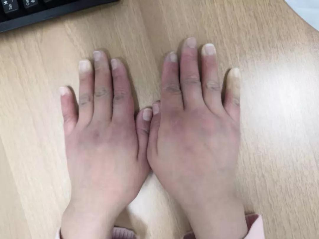 “手指、腳趾發白、發紫……”這些“小毛病”千萬別大意