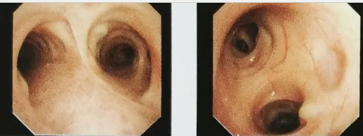 西安國際醫學中心醫院成功開展首例鞘管引導的經支氣管鏡冷凍肺活檢術GS-TBLC