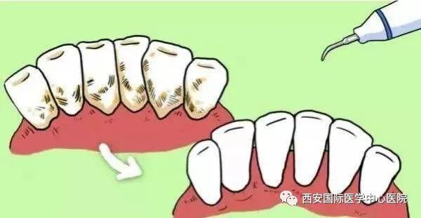 牙齒上的黃斑好難看，三招告訴你如何預防氟斑牙
