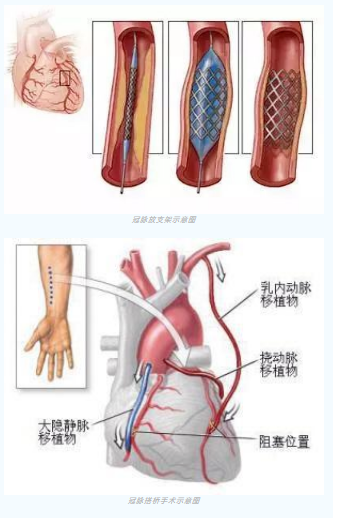 魚與熊掌不可兼得？冠脈雜交手術一站式解決問題