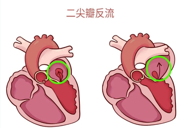 體檢報告里的心臟瓣膜返流，你讀懂了嗎？